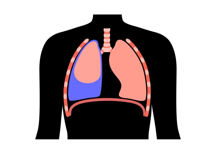 Pleural effusion disease. Fluid between the layers of tissue in lungs and chest cavity. DIfficult breathing. Unhealthy internal organs in the human body. Respiratory system medical vector illustration